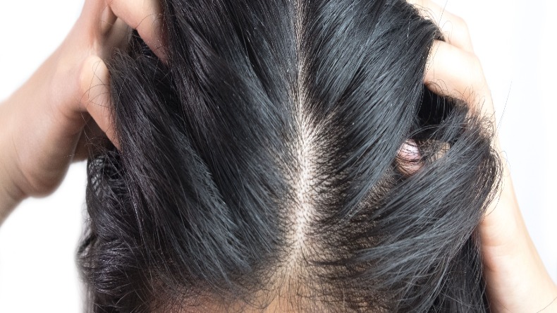 Scalp Psoriasis: जानें सिर पर ड्राईनेस और खुजली होने का कारण, ऐसे पाएं इससे छुटकारा