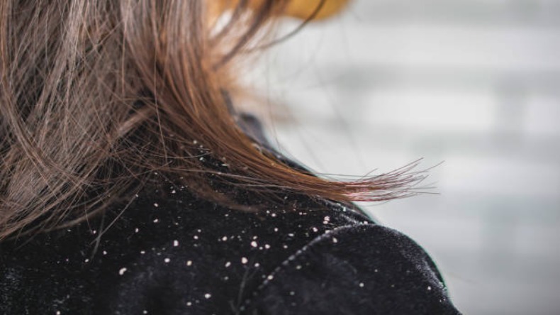 Winter Hair Care: बालों के डैंड्रफ से हैं परेशान, तो सर्दी में शैंपू करते समय इन बातों का रखें ध्यान