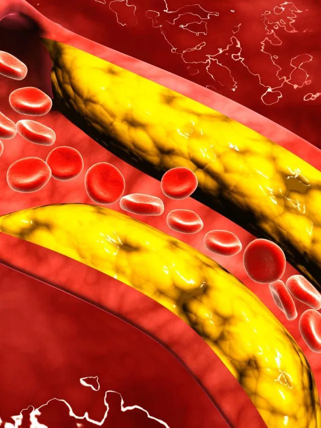 ये 4 लक्षण चीख-चीखकर बताते हैं खून में बढ़ गया कोलेस्ट्रॉल